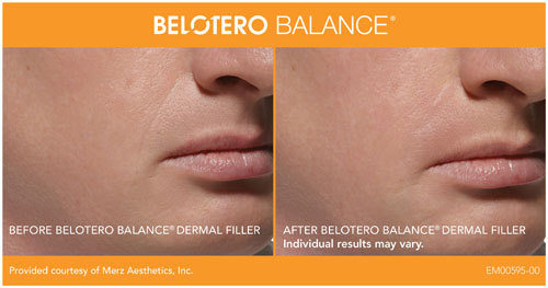 Belotero Before and After2