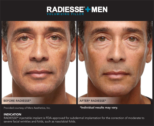 Radiesse Before and After6