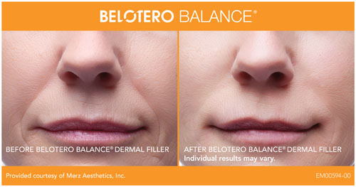 Belotero Before and After1