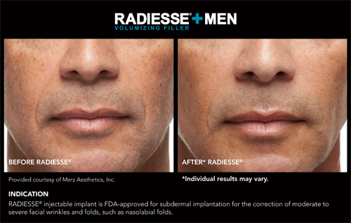 Radiesse Before and After2