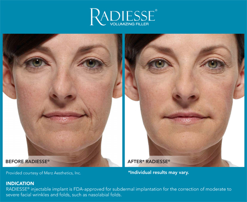 Radiesse Before and After3