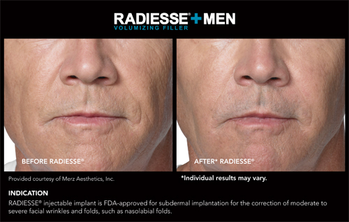 Radiesse Before and After4